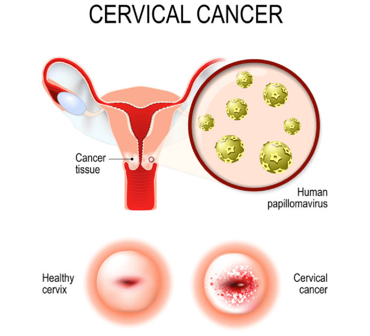 hpv causes mild dysplasia)